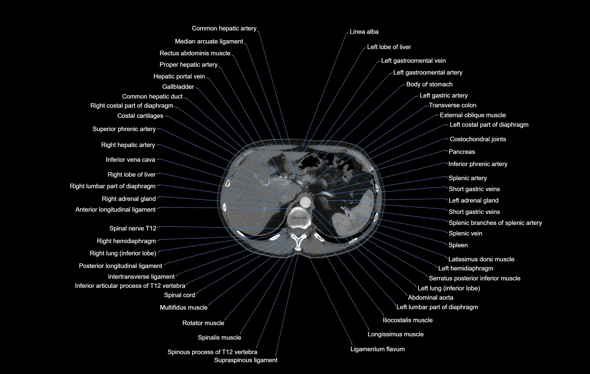 CT chest (thorax) soft tissue window labelled axial cross sectional anatomy radiology image-00118.webp